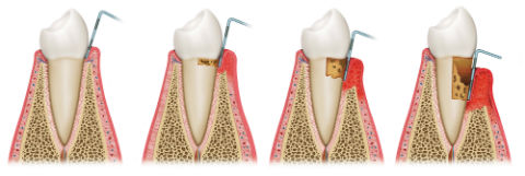 Periodontal Treatment | Madsen and Hirsch Dental Care | Madison, WI Dentists