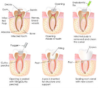 Root Canals | Madsen & Hirsch Dental Care | Dentist Madison, WI