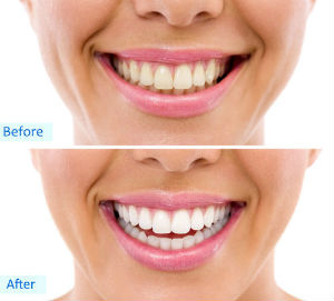 Teeth Whitening | Madsen and Hirsch Dental Care | Madison, WI Dentists