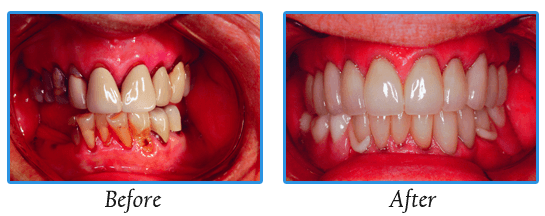 Dentures | Dr. Madsen and Dr. Hirsch | Madison, WI Dentists