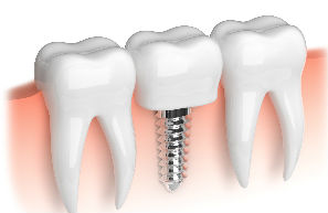Implant Dentistry | | Madsen & Hirsch Dental Care | Dentist Madison, WI